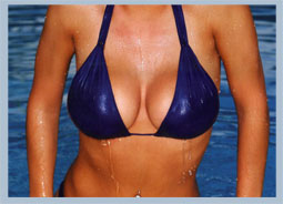 Breast Implants LA