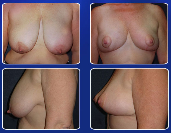 Breast implants oklahoma city