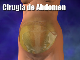 Cirugia de Barriga Operacion de Panza