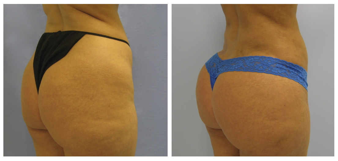 Where To Buy Brazilian Butt Lift