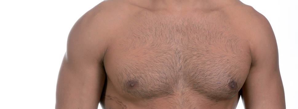 reducción de senos masculinos