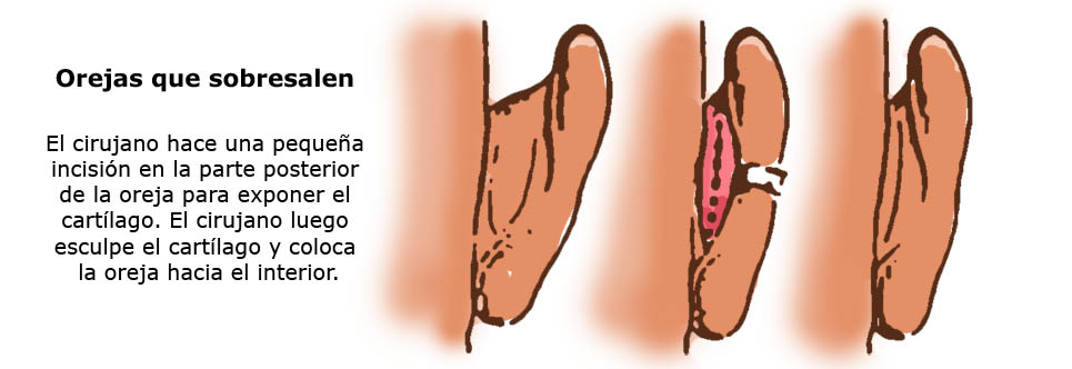 Infographic:Cirugia Reconstructiva de Oreja