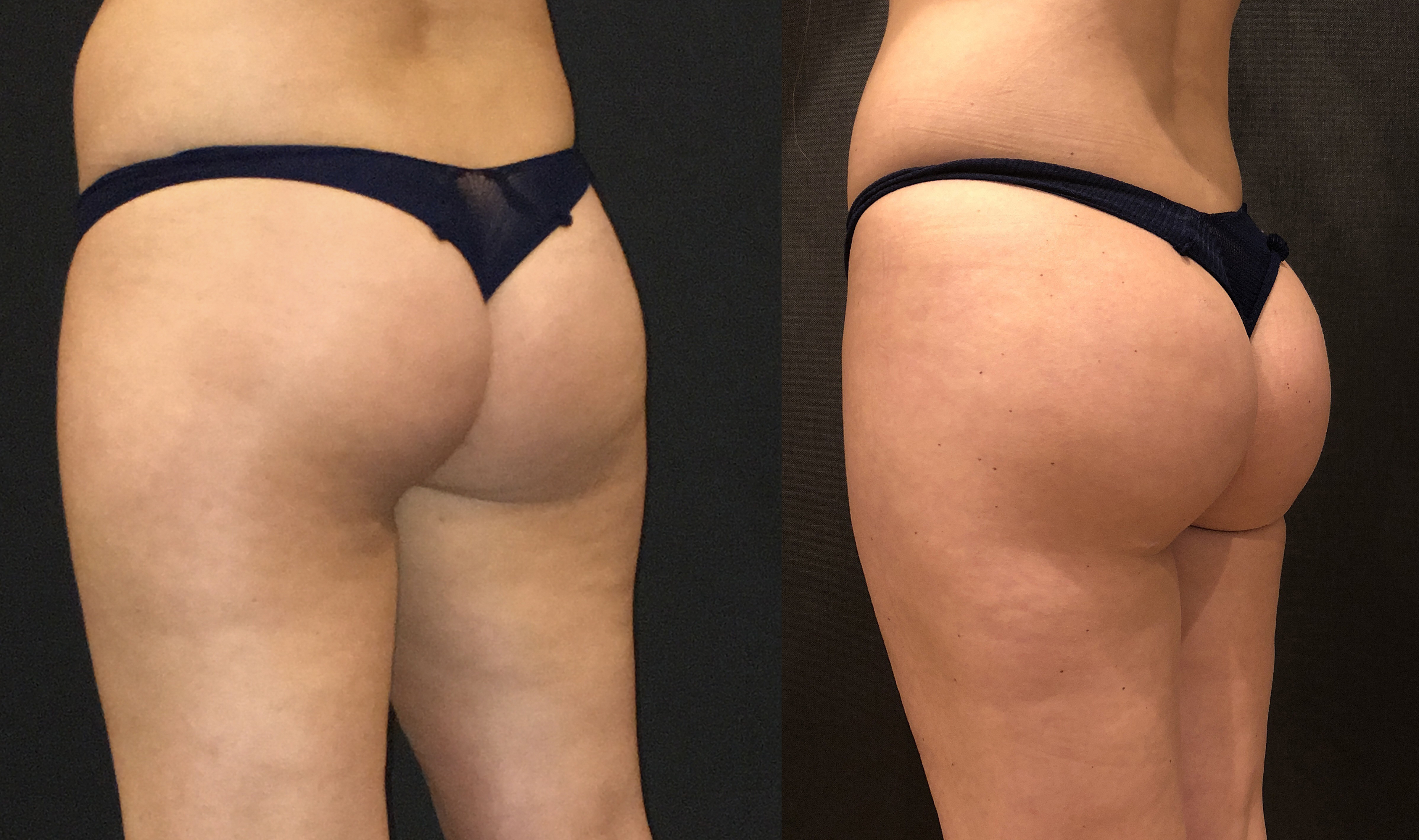 Tustin sculptra butt lift because nothing gets left behind